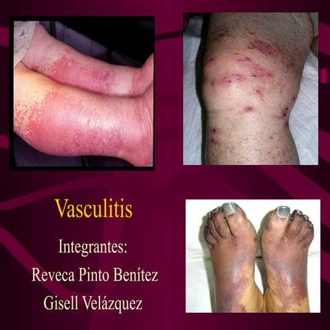 Vasculitis 