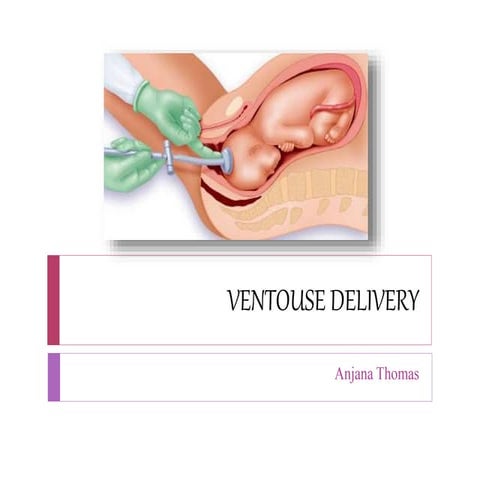 Ventouse delivery