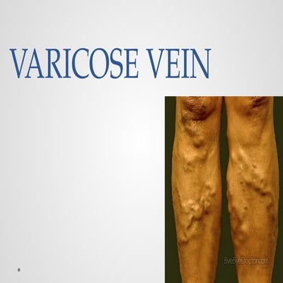 VERICOSE VEIN.pptx adult health nursing 1