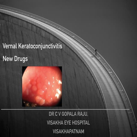 Vernal keratoconjunctivitis 