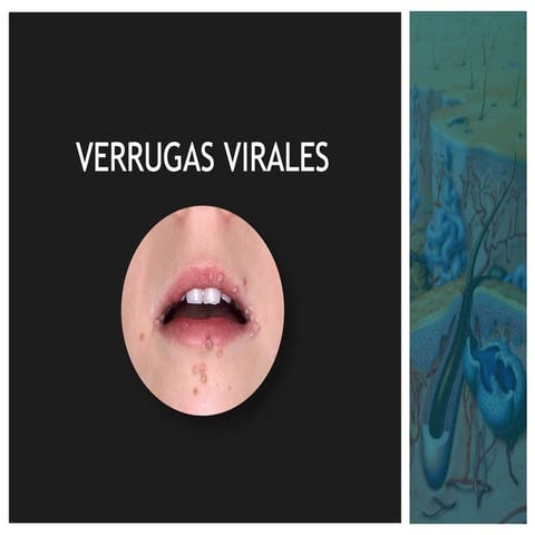 Verrugas (planas, acuminadas, plantares, vulgares) | PPTX