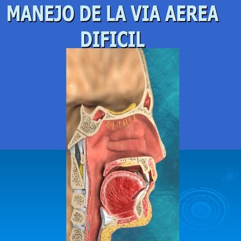 Via aerea dificil . lobitoferoz13