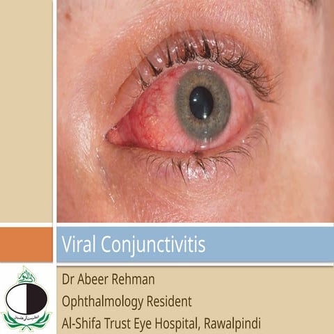 Viral Conjunctivitis and it;s managment.pptx
