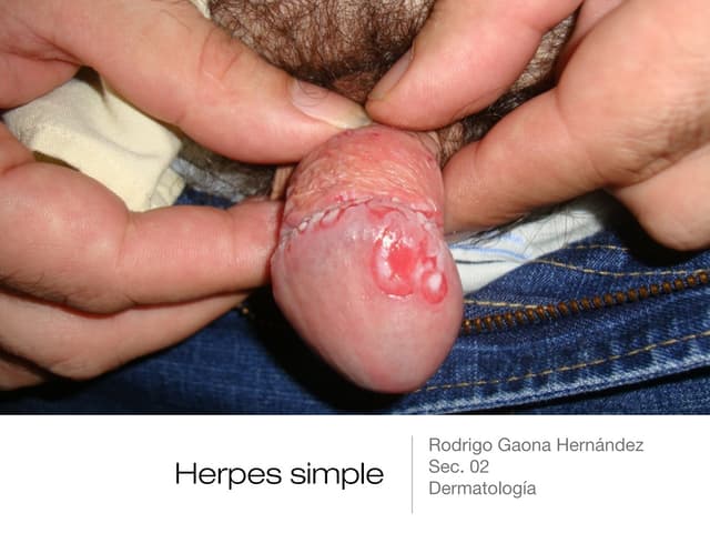 Herpes simple