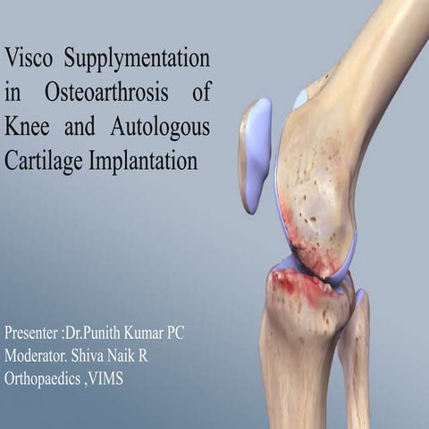 Visco supplymentation in osteoarthrosis of knee and autologous   copy