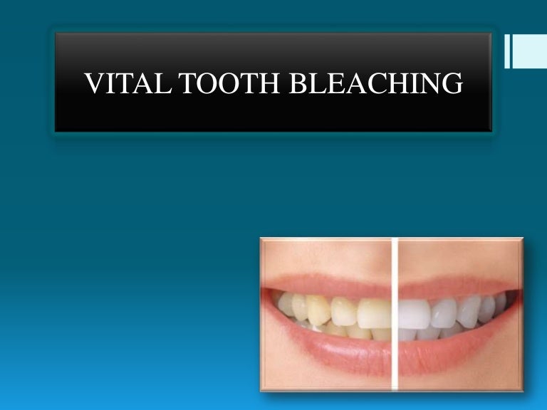 Vital tooth bleaching