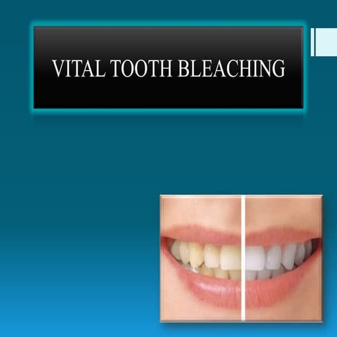Vital tooth bleaching