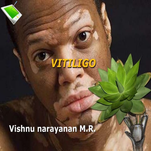 Vitiligo