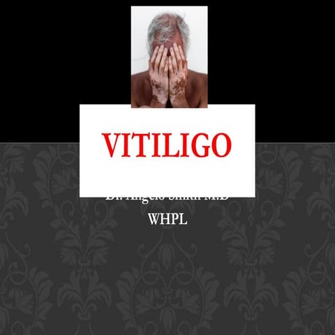 Vitiligo | PPT