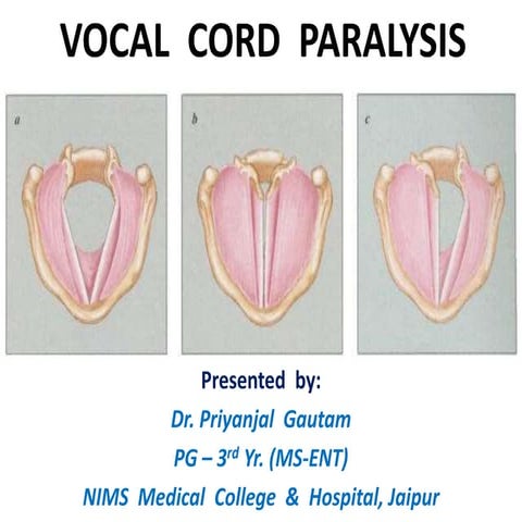 vocal-cord-paralysis-ppt