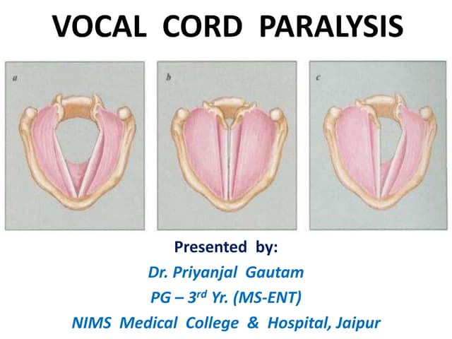Vocal Cord Paralysis PPT vocal-cord-paralysis-ppt