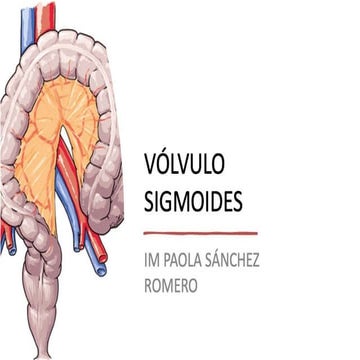 DIAPOSITA SOBRE VÓLVULO SIGMOIDES 2025!! | PPTX