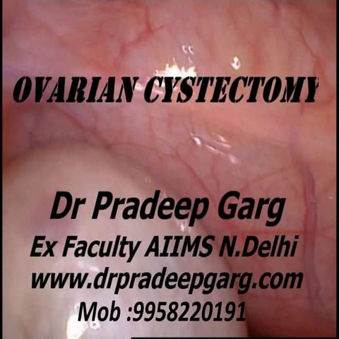 Laparoscopic Ovarian Cystectomy : Dr Pradeep Garg