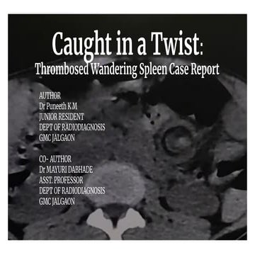 Wandering Spleen Final infract in spleen seen | PDF