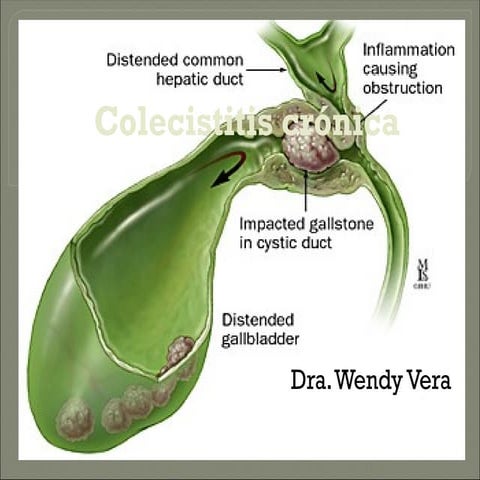 Wendyvesixula biliarColecistitis-cronica-ppt.pptx