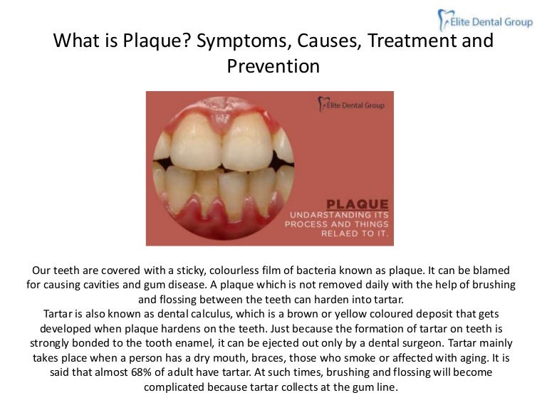 WHAT IS PLAQUE? SYMPTOMS, CAUSES, TREATMENT AND PREVENTION
