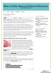 What Causes Angular Stomatitis?