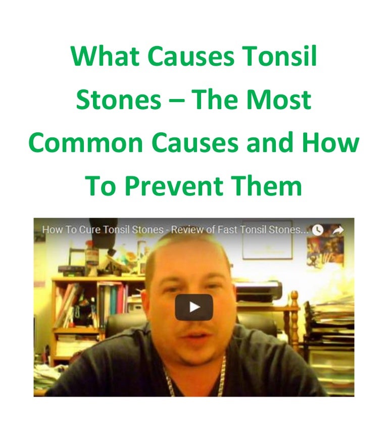 What causes tonsil stones the most common causes and how to prevent t…