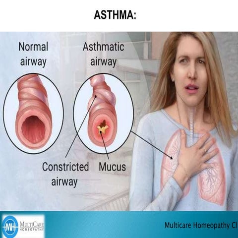 What is asthma  how can asthma be prevented 1