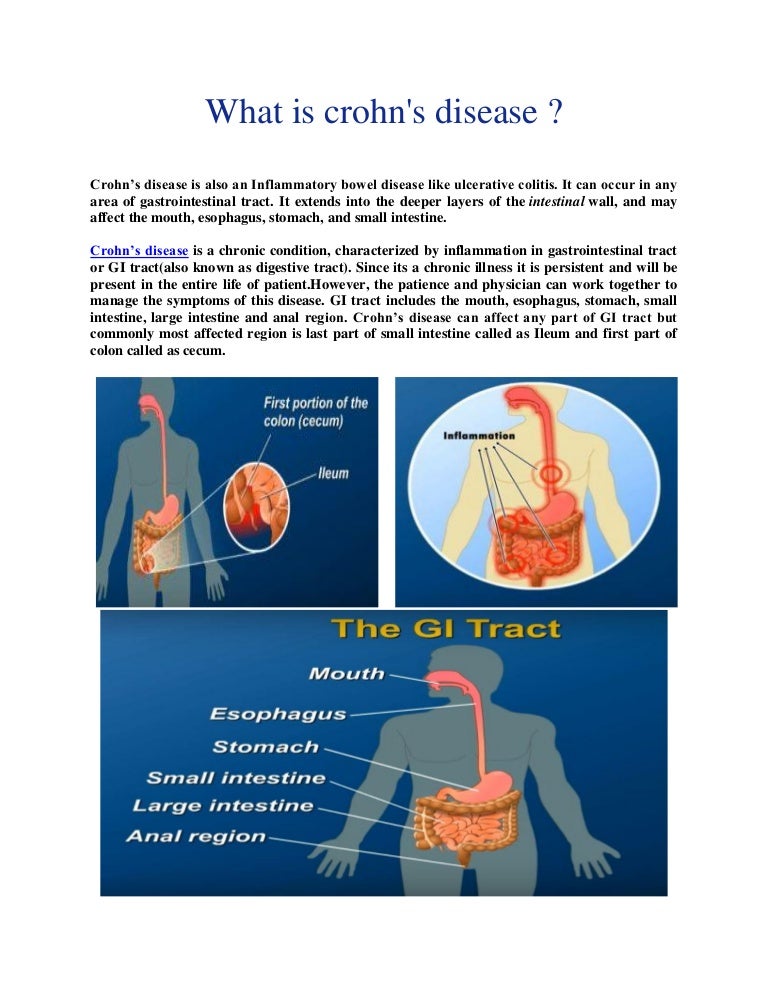 Crohn’s disease causes, symptoms and treatment