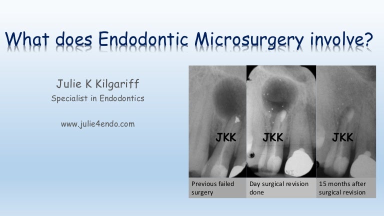 What Is Involved In Endodontic Surgery 