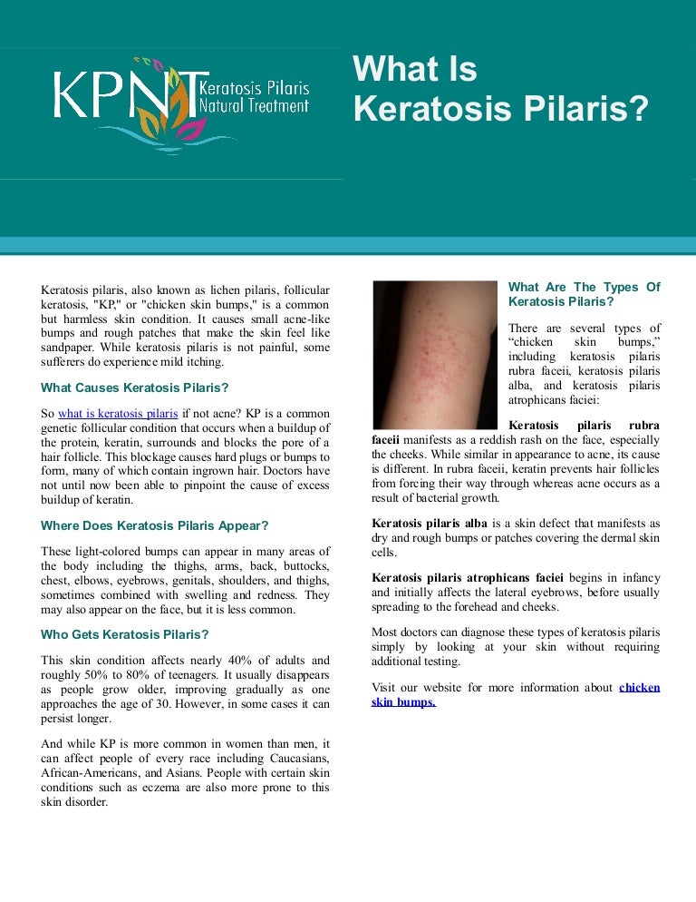 What Is Keratosis Pilaris