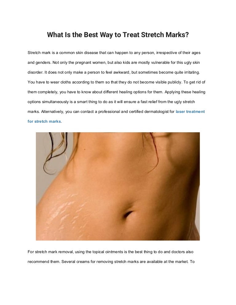 topical cream for stretch marks