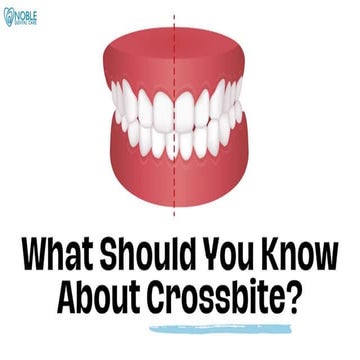 What Should You Know About Crossbite - Noble Dental Care