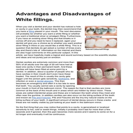 Advantages of White fillings - Dr Muzzafar Zaman