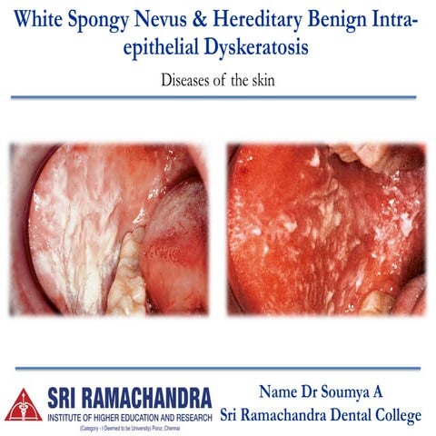 white-spongy-nevus-hereditary-benign-intraepithelia-dyskeratosis-pdf