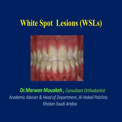 White spot lesions 
