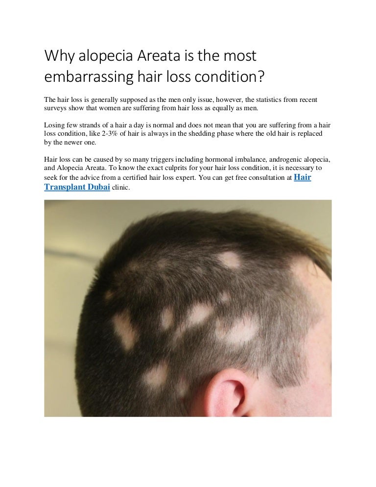 Why Alopecia Areata Is The Most Embarrassing Hair Loss Condition Outp