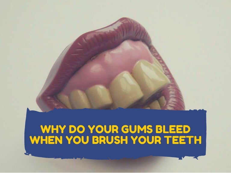 Why Do Your Gums Bleed When You Brush Your Teeth