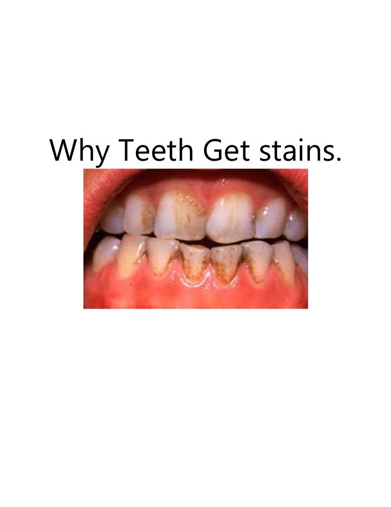 Why teeth change colour.