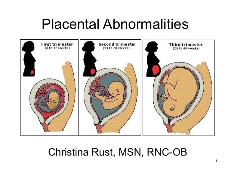 Wiki.placental abnormalities1