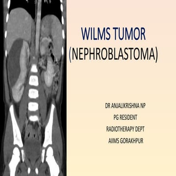 WILMS TUMOR (3).pptx radiation loncology | PPTX