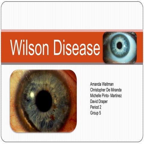 Wilsons Disease Skin Ocular Manifestations Of Liver Disease In