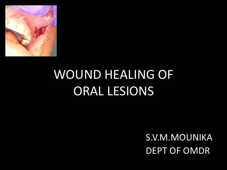 Wound healing of oral lesions