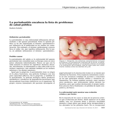 Periodontitis | PPTX