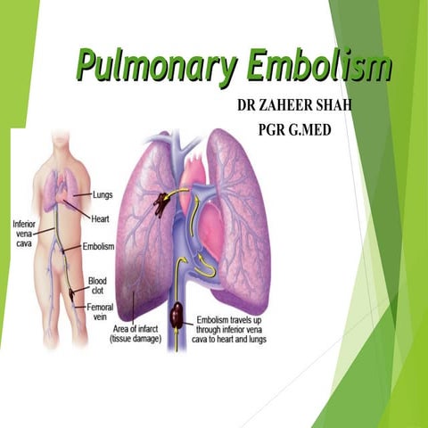Xaheer shah...pulmonary embolism