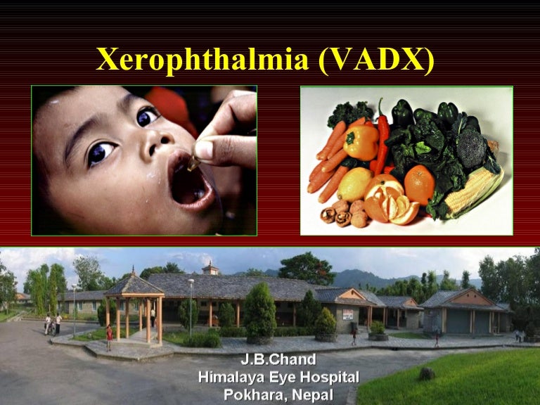 Xerophthalmia Xerophthalmia