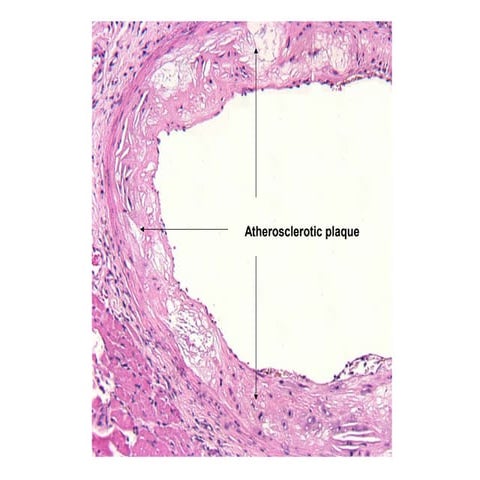 Atherosclerotic plaque