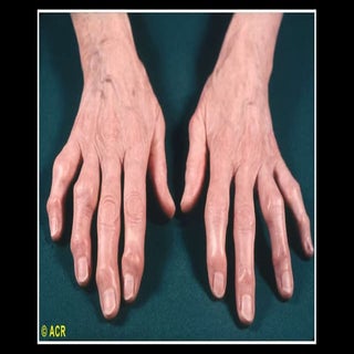 Radiología de la Osteoartrosis