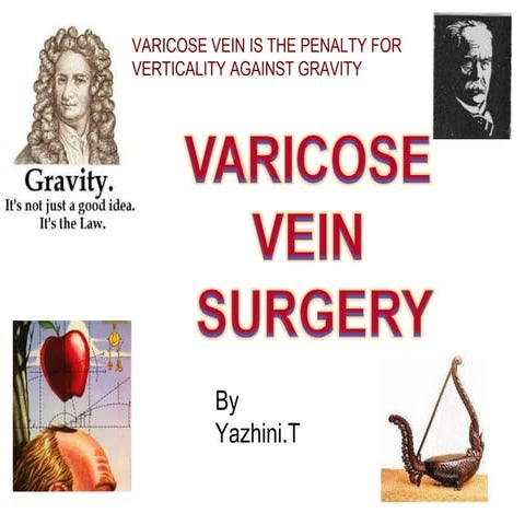  varicose vein surgery