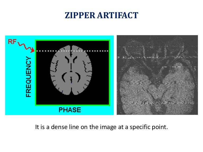 Zipper artifact