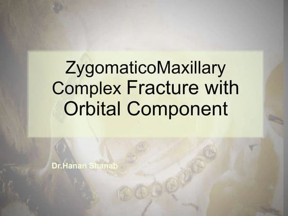 Zmc fractures part 1 | PPTX