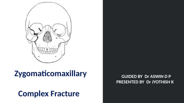 Zmc fractures part 1 | PPTX