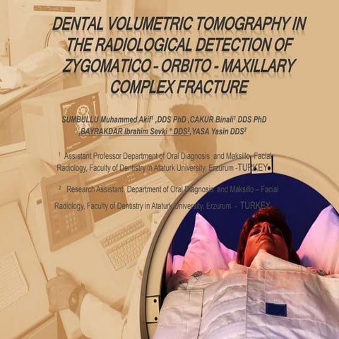 zygomatic bone fractures presentation.ppt