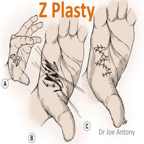 Z plasty in scar contracture release
