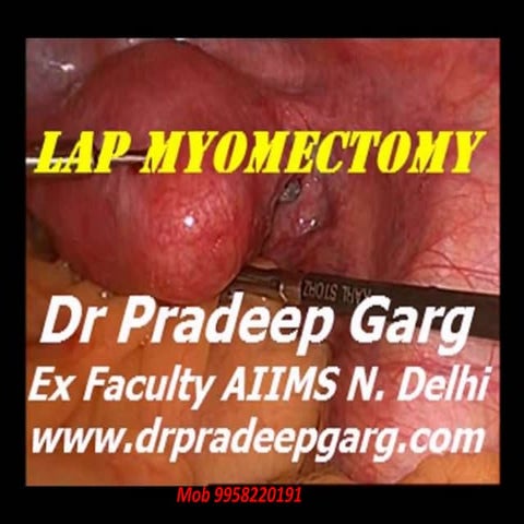 Laparoscopic Myomectomy : Basics : Dr Pradeep Garg